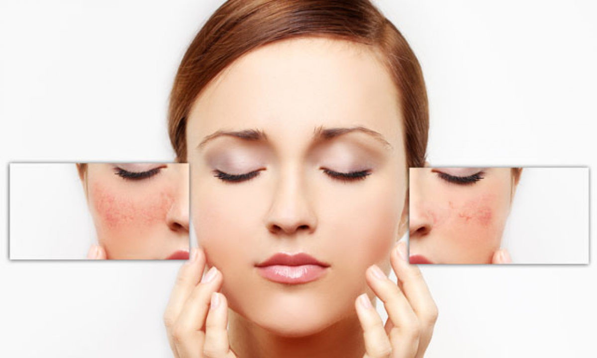 Aftercare for Skin Resurfacing Treatment