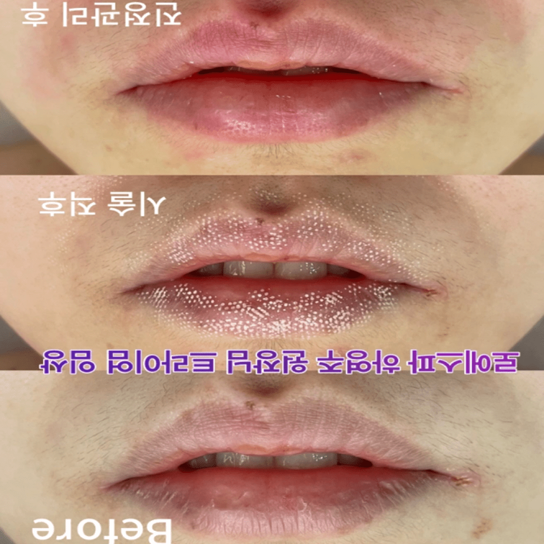 Pore Reduction