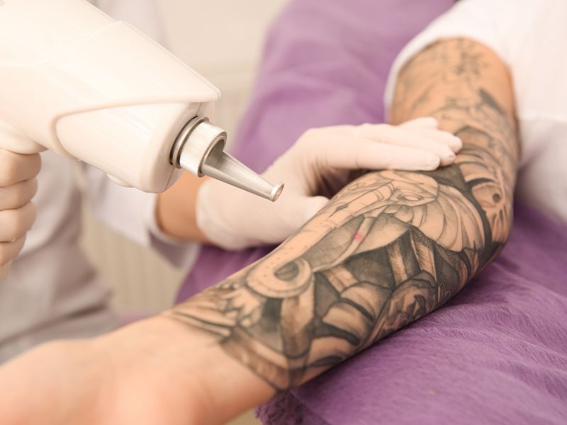 Benefits of KorinMi Luminex Tattoo Removal