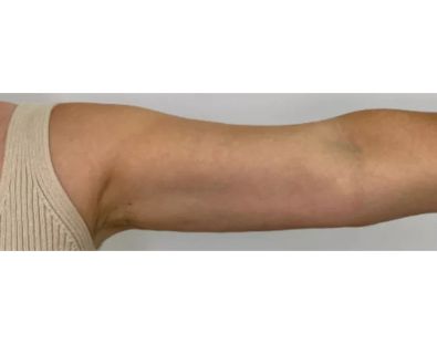 After Treatment
