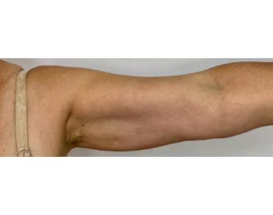 Before Treatment