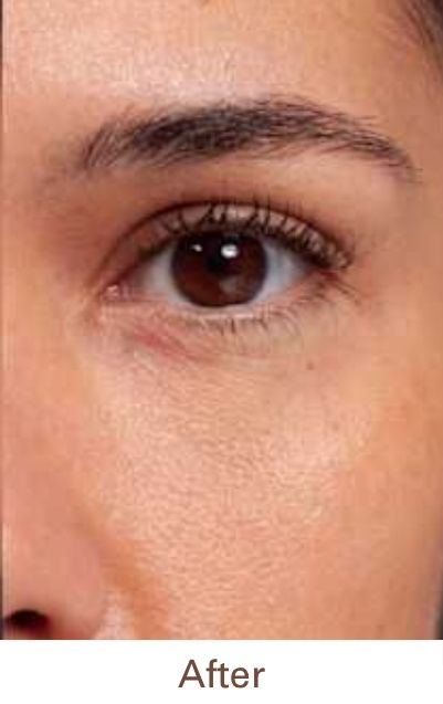 After Treatment