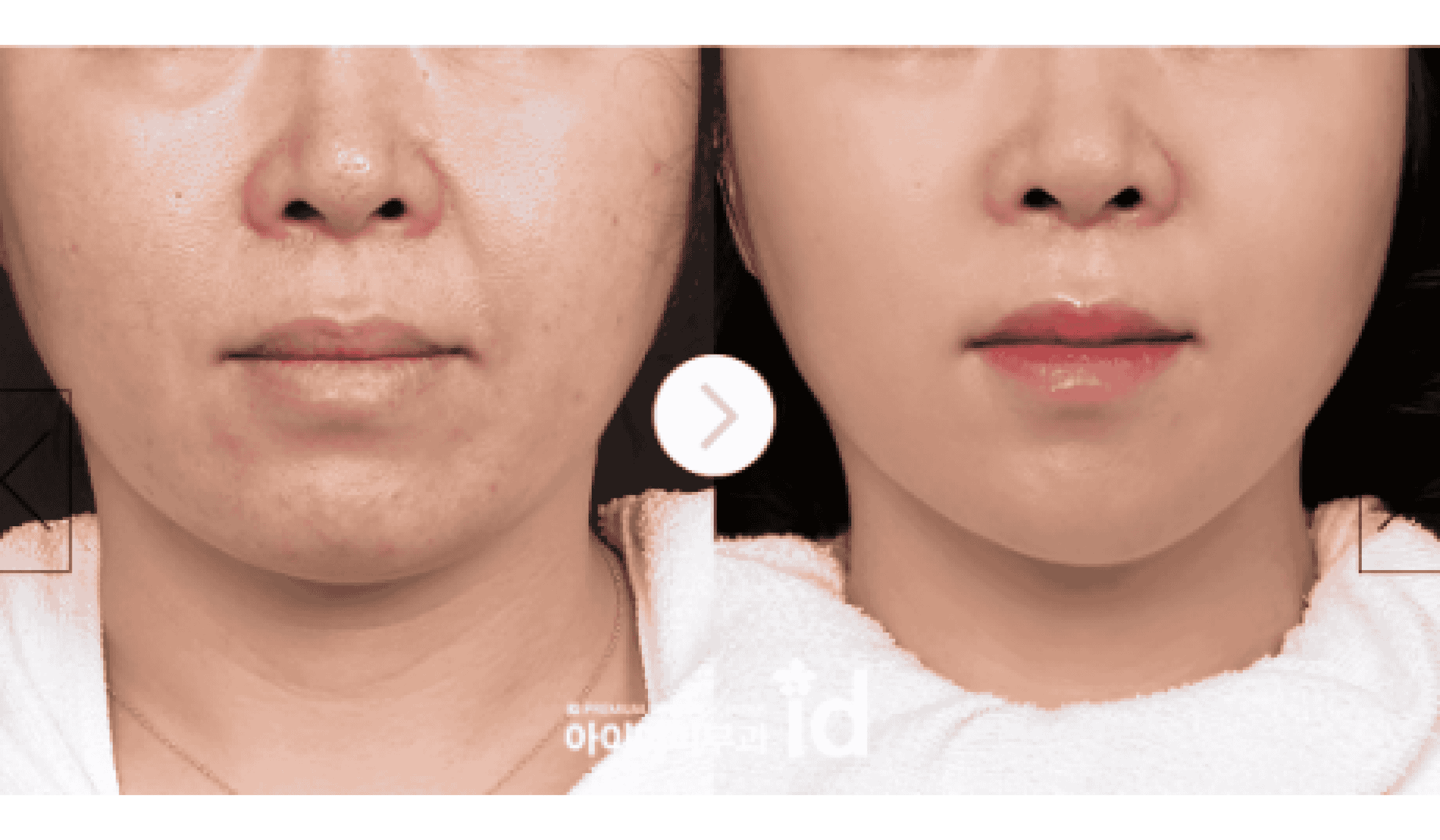 Xylift Facial Sculpt