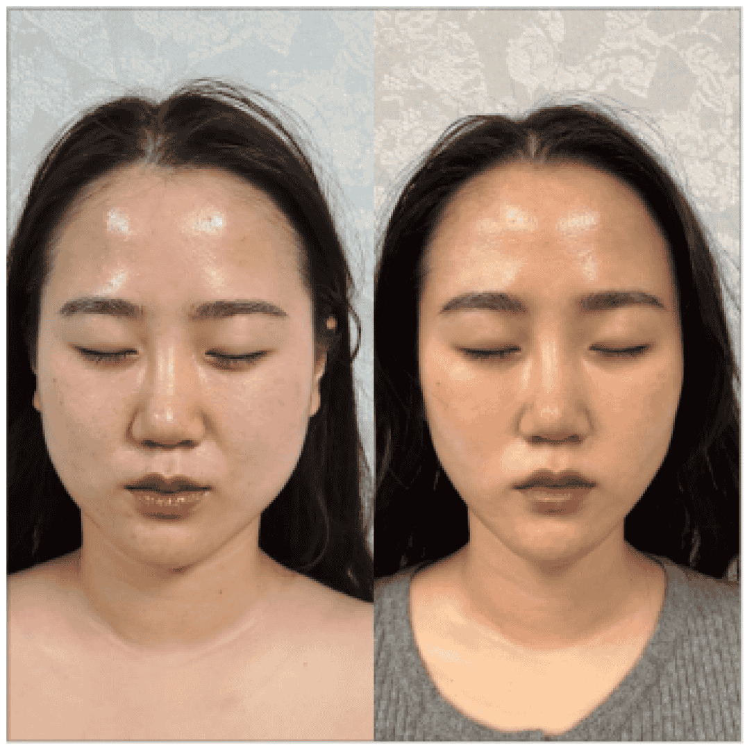 Precision Facial Contouring