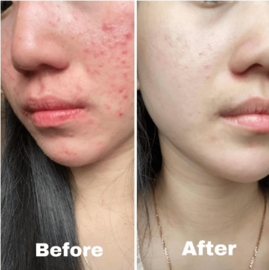 KorinMi Glass Skin Resurfacing Treatment