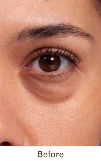 Before Treatment