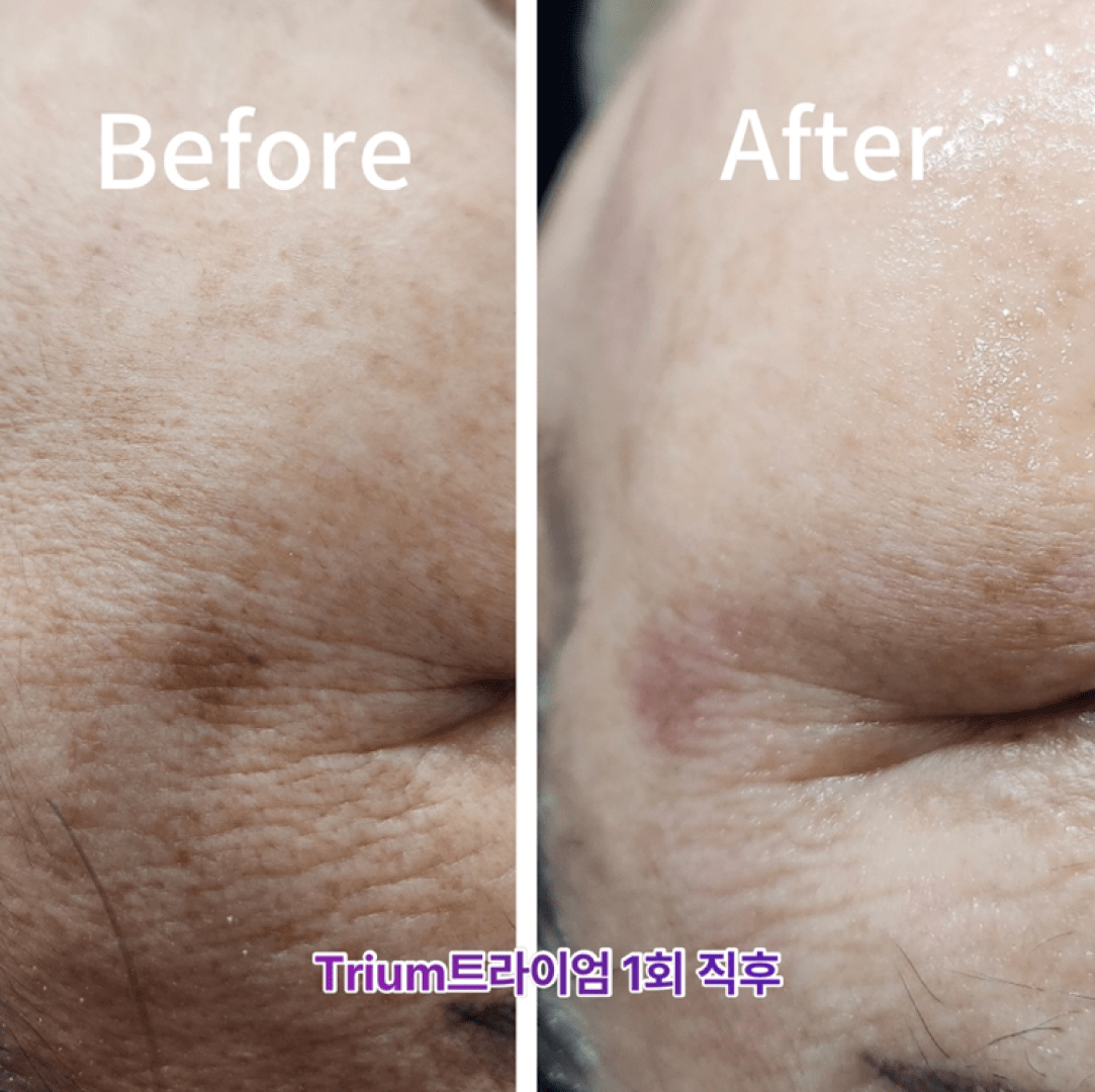 Collagen Regeneration