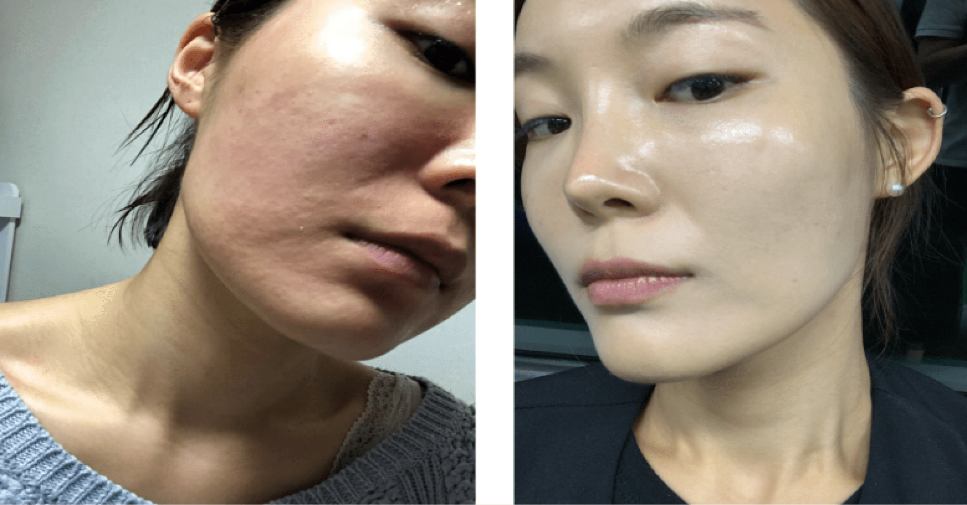 KorinMi Diamond Glass Skin Treatment