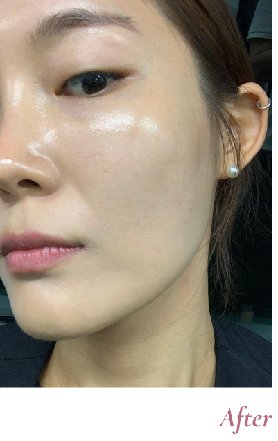 After Treatment