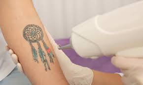 Aftercare for KorinMi Luminex Tattoo Removal